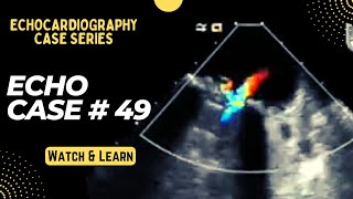 Echocardiography Case 49 Echo Spot Diagnosis Series  Cardiology TOACS [upl. by Aitat]