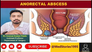 Anorectal Abscess Lecture [upl. by Amaty]