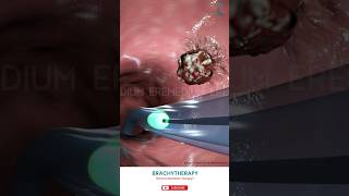 Know About Brachytherapy ↪ 3D Medical Animation Brachytherapy InternalRadiationTherapy [upl. by Assirod]