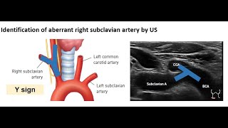 ENGAberrant right subclavian artery [upl. by Michigan]