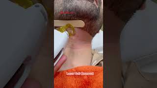 Laser Hair Treatment getsmarthairclub viralvideo skincare [upl. by Fiann]