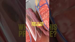 What is this procedure Video credit Prof Dr Sedat Belli YouTube Thanks for this video [upl. by Colligan610]