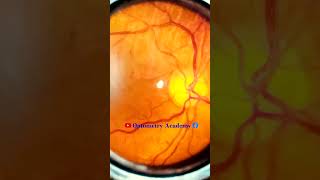 Normal fundus  Normal Retina  Smartphone Fundus Videography  Fundus Photography  Short Video 91 [upl. by Any]