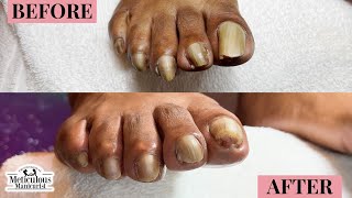 Thick Yellow Toenails  Client Pedicure Transformation [upl. by Hultgren]