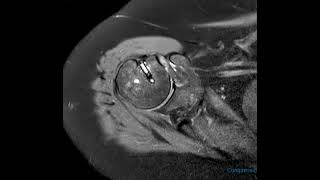 Subcoracoid impingement in 60 year old [upl. by Atikkin12]