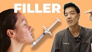 How to Fix ACNE SCARS with Dermal Filler  Dr Davin Lim [upl. by Nore]