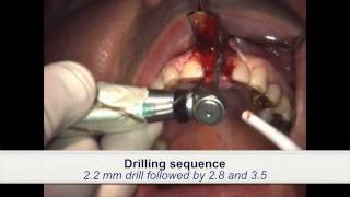 Dental Implant Placement in patient treated with iv bisphosphonates [upl. by Kraft]