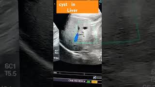 ultrasound abdomenhepatic cyst cyst in liver [upl. by Weissberg]