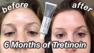 6 Month TretinoinRetinA Update Before amp After  My Current Skincare Routine [upl. by Rentschler]