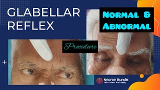 Glabellar Reflex  Myerson’s Sign reflexpathway cranialnerves positiveprimitivereflex neurology [upl. by Cotterell]