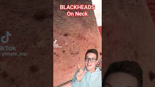 Crazy BLACKHEAD REMOVAL FROM NECK  Perfection shorts [upl. by Bryon]