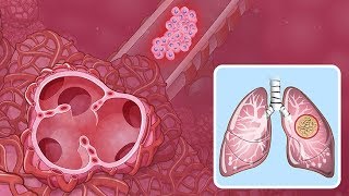 Understanding NonSmall Cell Lung Cancer [upl. by Jasisa]