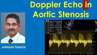 Doppler Echocardiography in Aortic Stenosis [upl. by Ardiedak840]