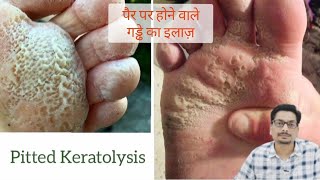 Pitted Keratolysis  Erythrasma  पैर पर होने वाले गड्ढे का इलाज़ fungalinfection fungalinfections [upl. by Ribaj]