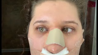 MY NOSE GOT BIGGER THAN BEFORE AFTER NOSE JOB RHINOPLASTY VLOG [upl. by Ateikan]