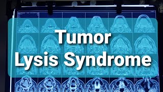 Tumor Lysis Syndrome [upl. by Ottie]