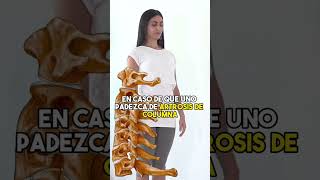 Ejercicio para la escoliosis escoliosis fisioterapia fisioterapia yoga clasegratis shorts [upl. by Adnohr]