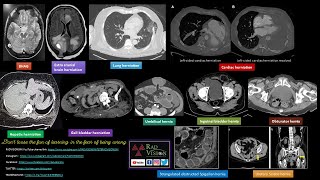 IMAGING IN HERNIAS CASE SPECTRUM [upl. by Alyakcim316]