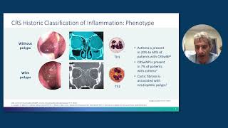 Rhinosinusitis With Nasal Polyps From Pathophysiology to Management [upl. by Fink]