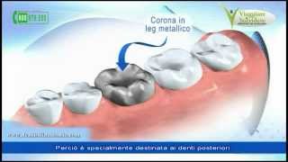 Le Corone Dentali le Capsule e i Denti in Ceramica metallo o zirconio [upl. by Enived]