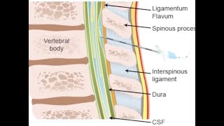 Thoracic epidural anesthesia [upl. by Airekat985]