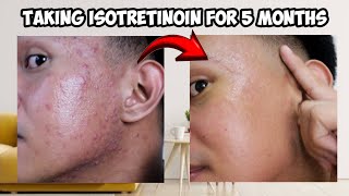 TAKING ISOTRETINOIN FOR 5 MONTHS  FIVE MONTHS UPDATE  ISOTRETINOIN JOURNEY Acnetrex [upl. by Wincer]