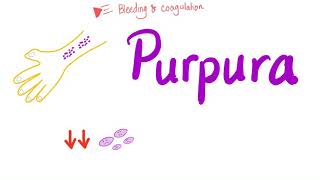 Pupura  Bleeding Disorders [upl. by Adihsar]