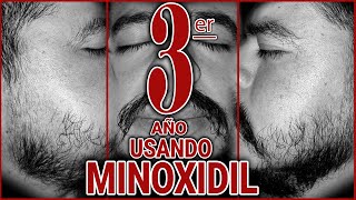 TRES AÑOS USANDO MINOXIDIL [upl. by Ayiak]