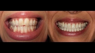 Invisalign Time Lapse UPDATED [upl. by Rosemare]