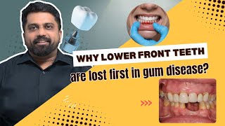 Why are lower front teeth lost first in gum diseases  DrPrem Alex Lawrence in tamil [upl. by Notnarb]