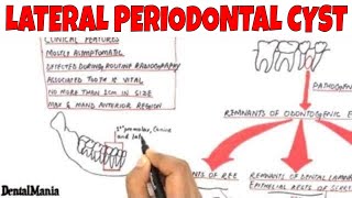 Lateral periodontal cyst  Pathogenesis Clinical Radiographic and Histopathologic features [upl. by Accissej]