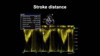 Echocardiography Essentials Assessing left ventricular global systolic function LVF [upl. by Nnybor242]