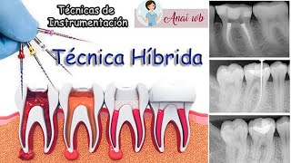 ENDODONCIA  Técnicas de Instrumentación Técnica Híbrida  PARTE 3 [upl. by Bianka431]