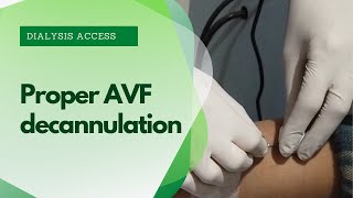 AVF Decannulation procedure  avf cannulation techniques [upl. by Niai]