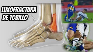 LUXOFRACTURA DE TOBILLO futbol fractura [upl. by Hurlow]