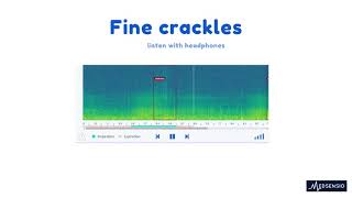 Lung sounds  fine crackles [upl. by Bahe]