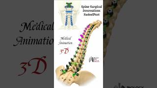 Spine Surgical Innovations SwivelPort medical animation 3d short  BiologywithAliya [upl. by Elkin]