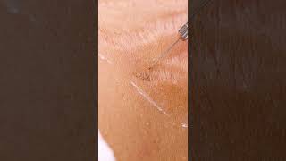 Up close view of how laser stretch mark removal works 😯 shorts [upl. by Reube271]