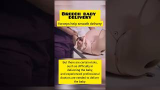 Breech Baby Delivery 🤰  breech baby medicalstudent satisfying medical shorts [upl. by Elery649]