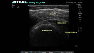 GLENOHUMERAL JOINT HYDRODILATATION  FROZEN SHOULDER [upl. by Mackenie566]