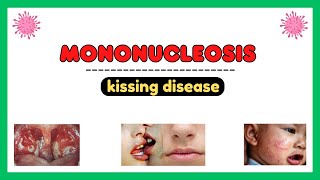 Mononucleosis infection epstein barr virus pathophysiology symptoms diagnosis treatment [upl. by Ayatnohs]