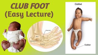 CLUB FOOTTALIPES EQUINOVARUSEpidemiology etiology risk factors classification and Management [upl. by Bumgardner985]