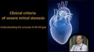 Clinical Criteria of Severe Mitral Stenosis Understanding A2 Opening Snap Gap amp Murmur Length [upl. by Nylave260]