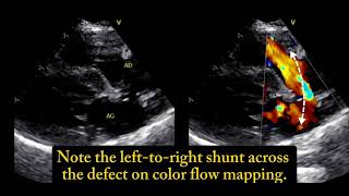 Ostium secundum atrial septal defect a 6 monthold cat 🐱 [upl. by Alaham]