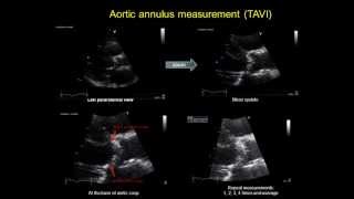 AORTIC ANNULUS MEASUREMENT  TAVI  transcatheter aortic valve implantation [upl. by Ahcas389]