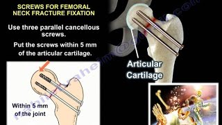 Hip Fractures  Everything You Need To Know  Dr Nabil Ebraheim [upl. by Sunil]