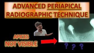 The Best Periapical X Ray Technique Angulation of Dental X Rays For Beginners How to take posterior [upl. by Christoffer]