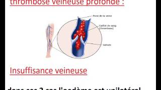 oedème des membres inférieurs [upl. by Aysan]
