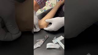 Treating Cubital Tunnel Syndrome [upl. by Repotsirhc117]