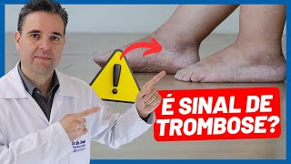 INCHAÇO NA PERNA É UMA TROMBOSE  Dr Alex Vascular [upl. by Eelesor]